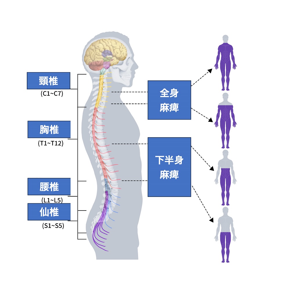 脊髄損傷の麻痺部位のイメージ画像