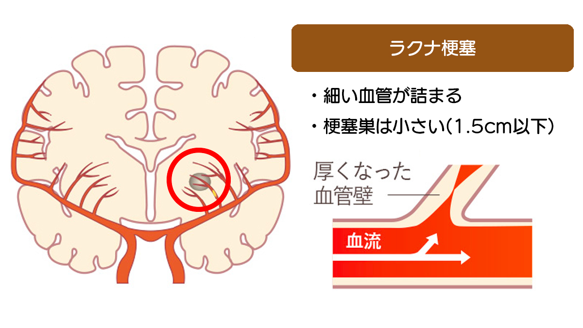 ラクナ 梗塞 と は