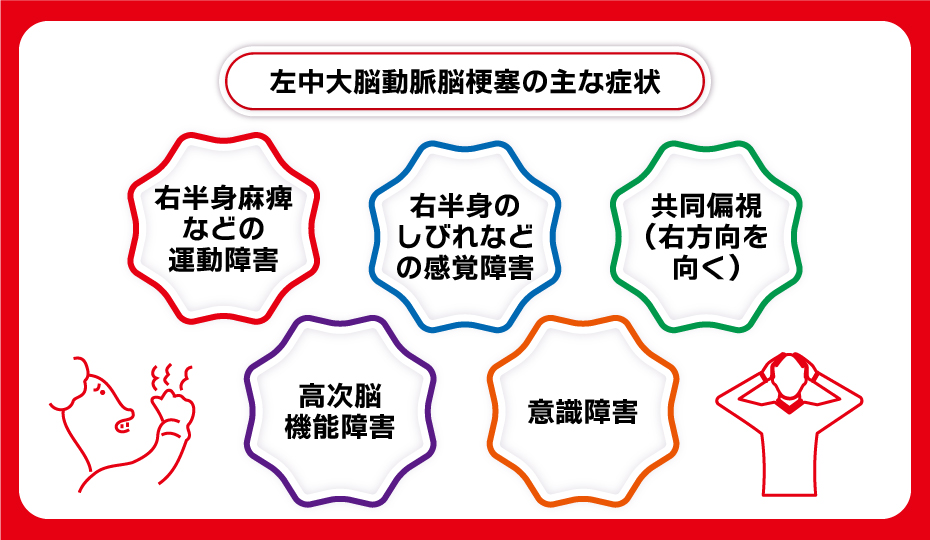 左中大脳動脈脳梗塞の主な症状