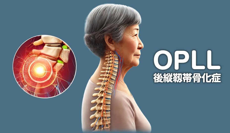 後縦靭帯骨化症と胸椎手術の基礎知識