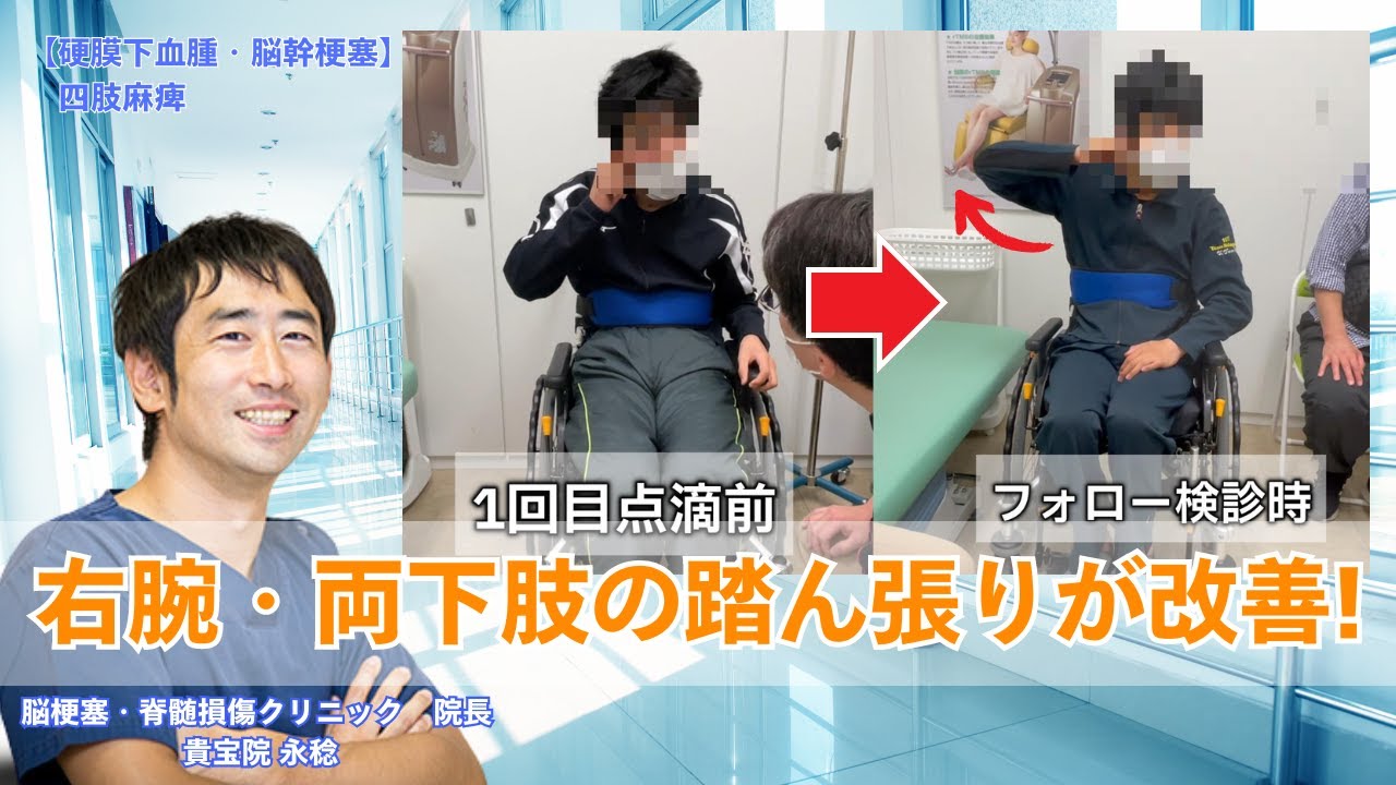 【10代男性｜急性硬膜下血腫・脳幹梗塞】事故から1年、不自由だった腕に回復の兆しが見られました！